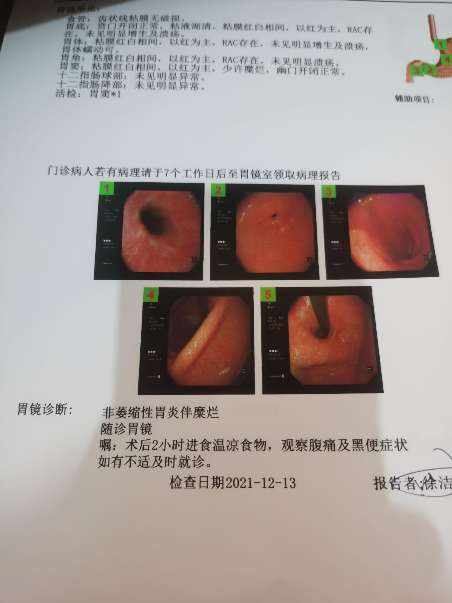 慢性非萎缩性胃炎伴糜烂能治好吗日常饮食有什么禁忌吗
