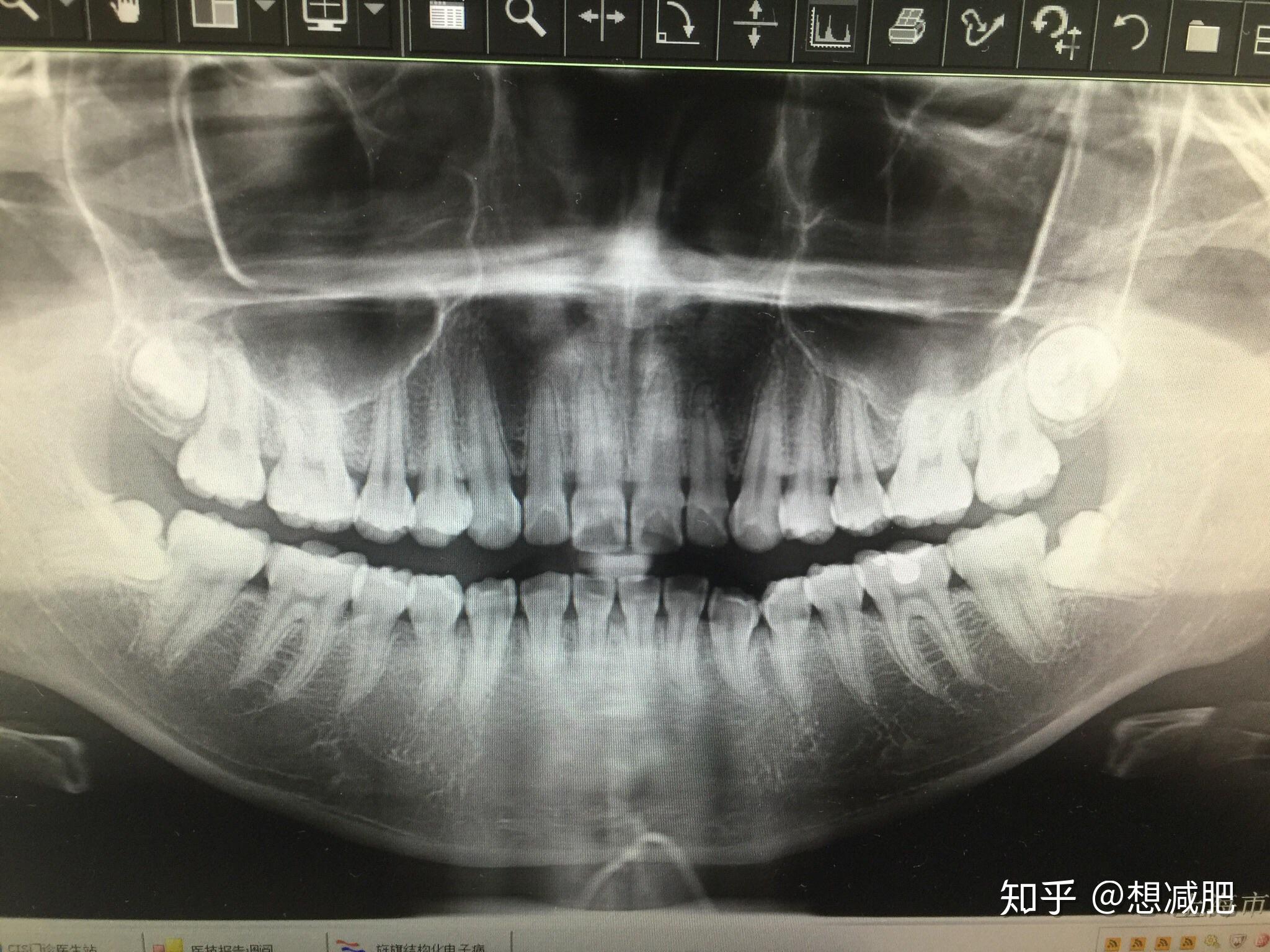 牙龈高度不一致，牙齿缺失，畸形过小牙，联合修复病例分享-谭敬宇住院医师-爱问医生
