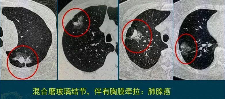 右肺上叶及左肺下叶见磨玻璃密度结节左肺上叶及右肺下叶见钙化灶是