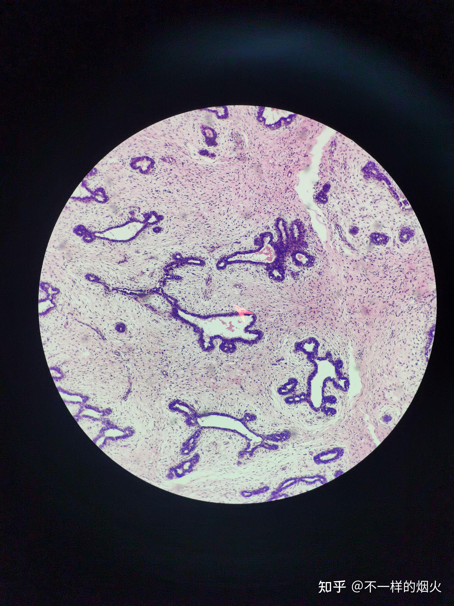 乳腺纤维腺瘤的镜下观