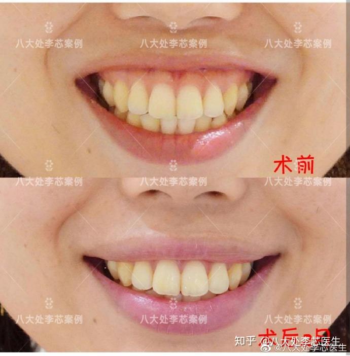 肉毒素注射上唇肌,缓解上唇肌张力过大,能有效改善露龈笑的问题