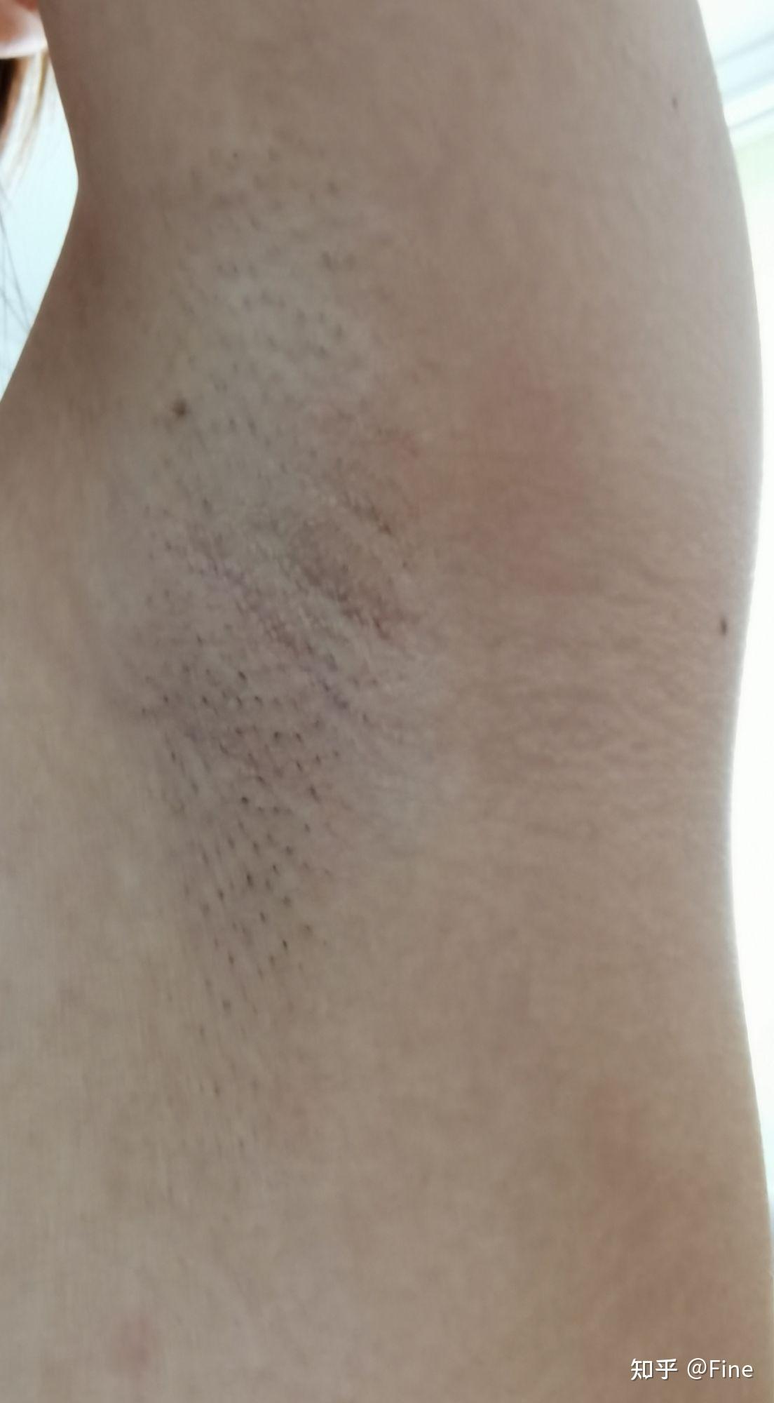 鸡皮肤怎么去腋毛推荐(用什么方法去腋毛比较好)