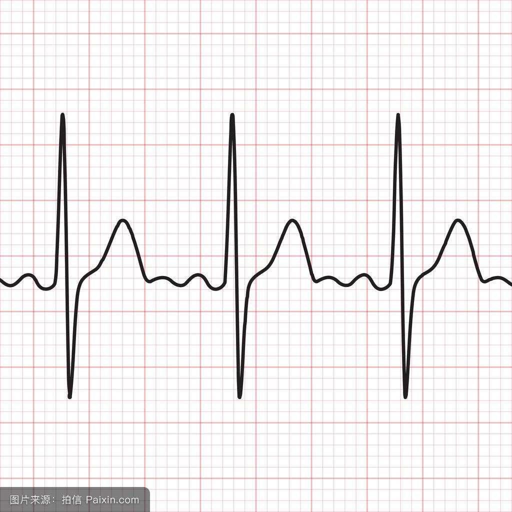 心电图学习系列之二：心动过速的形成和一般判断机制 - 简书