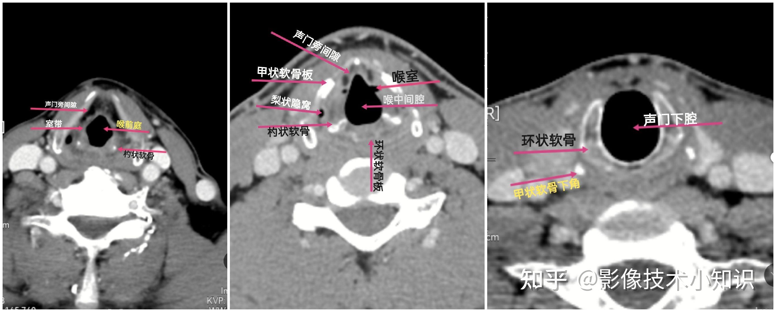 上方的一对称为前庭装,自甲状软骨前角中部连至杓状软骨声带突上方