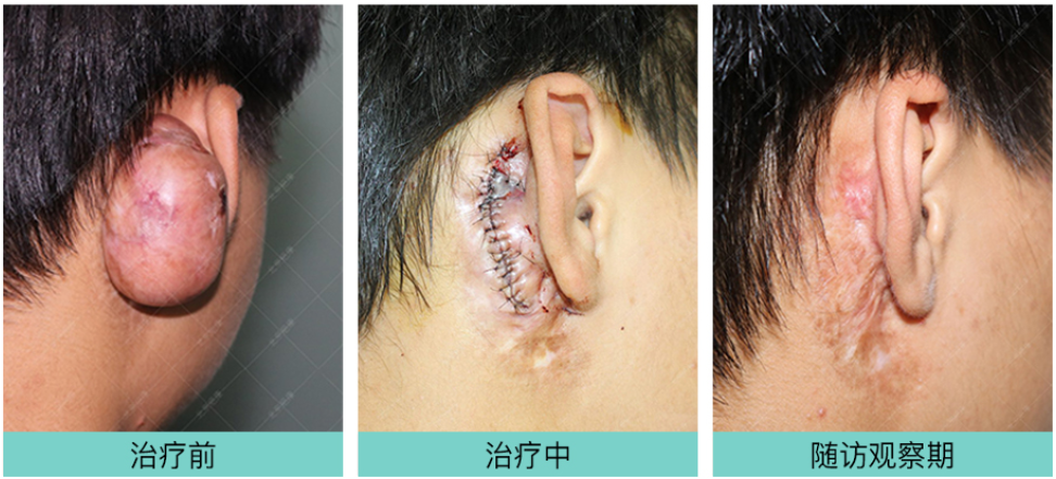 江西16岁小周耳朵手术疤痕疙瘩治疗案例