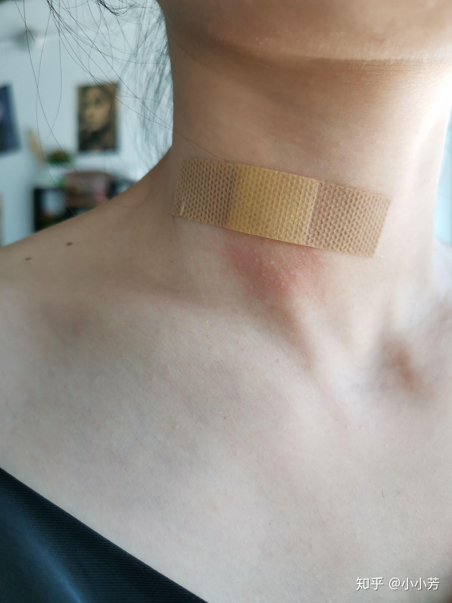 白醋祛除丝状疣