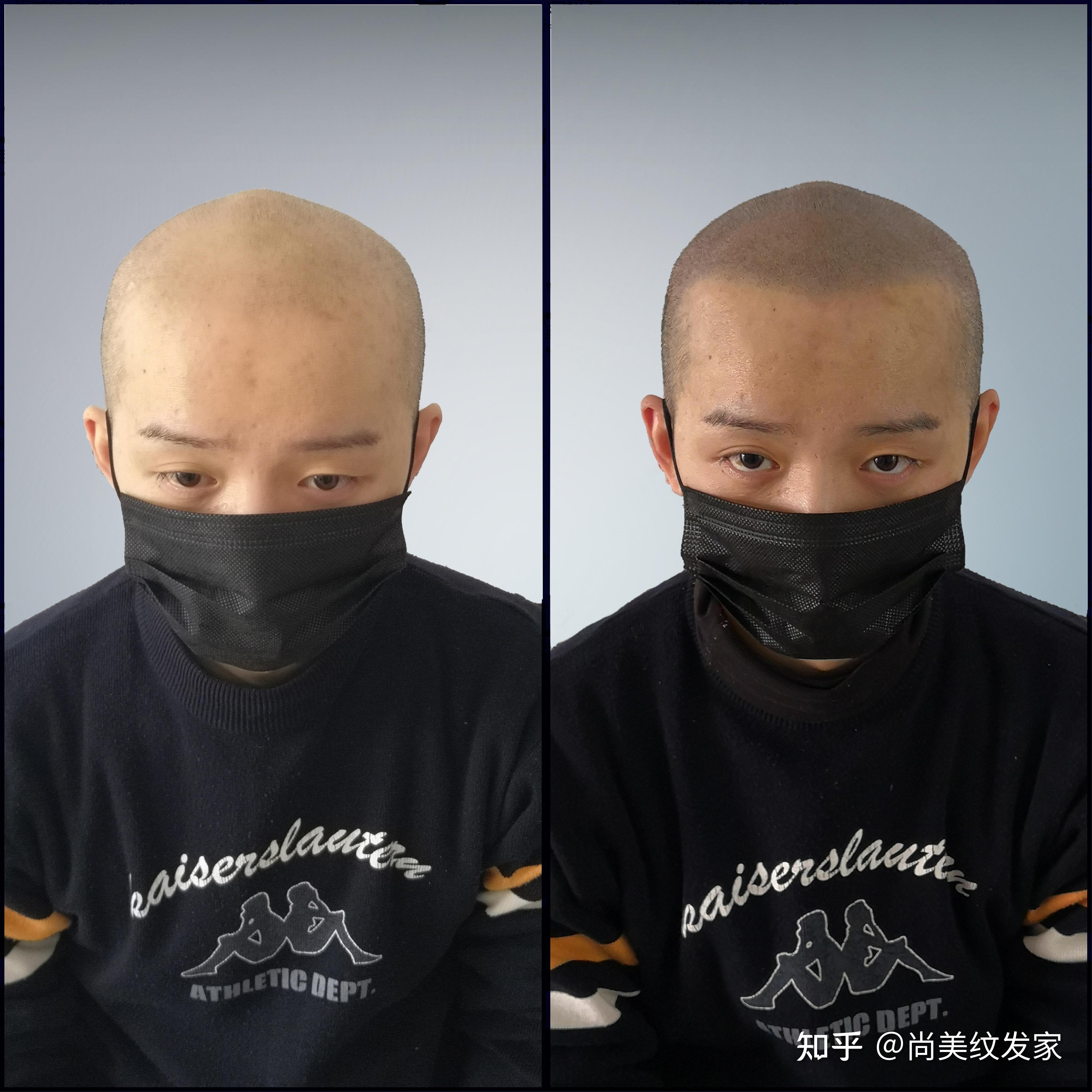 由於皮膚本身會代謝黑色素,以及您做smp 3d紋發時是以您現在的頭髮