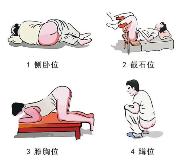 令人尴尬的肛门指检体检时到底要不要做这些人群建议做