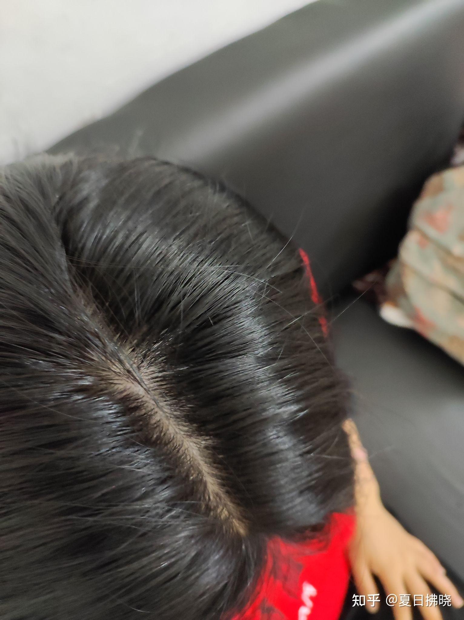 21岁女孩子,头秃成这样还有救吗? - 知乎