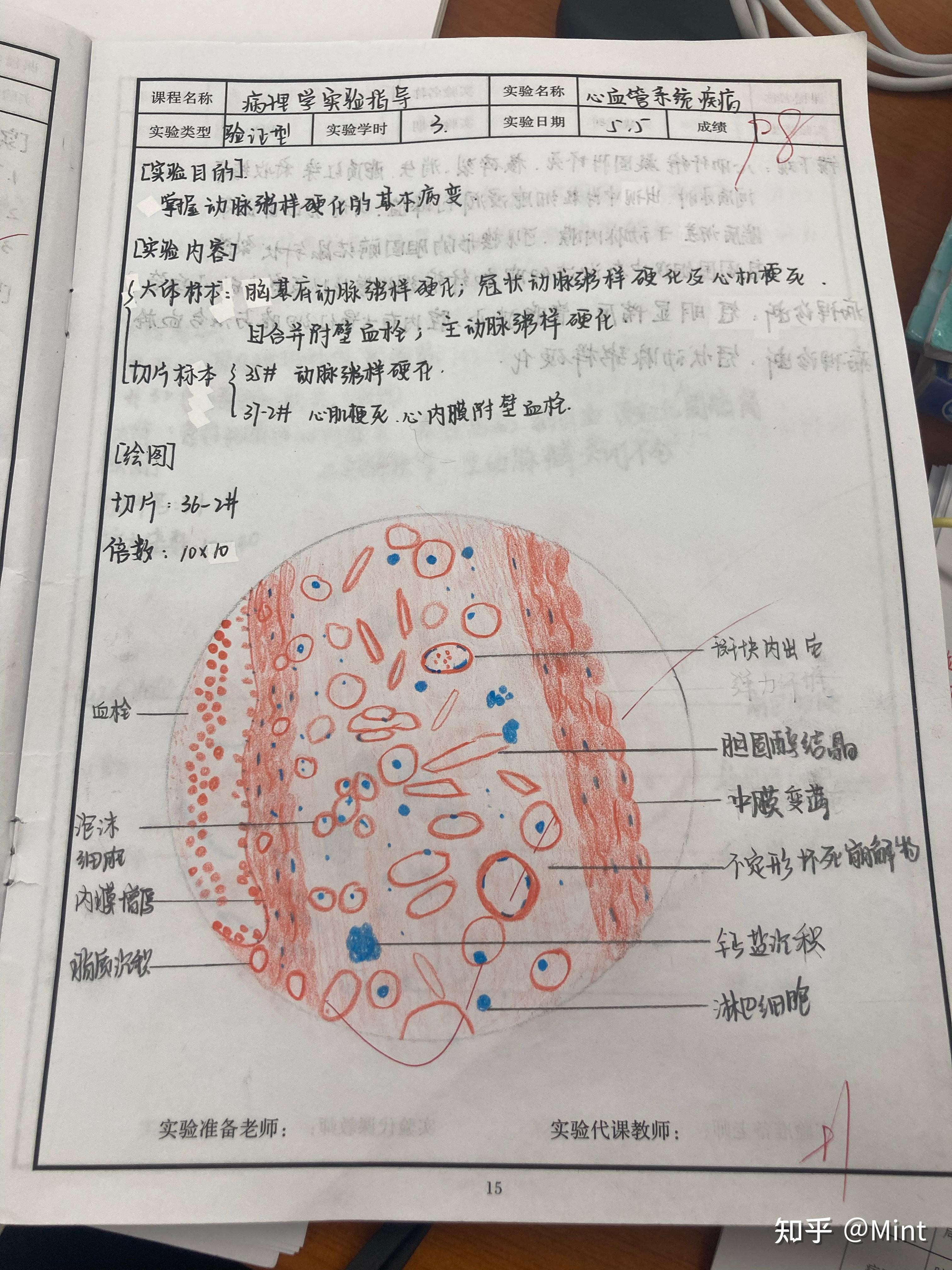 肾浊肿手绘实验报告图图片