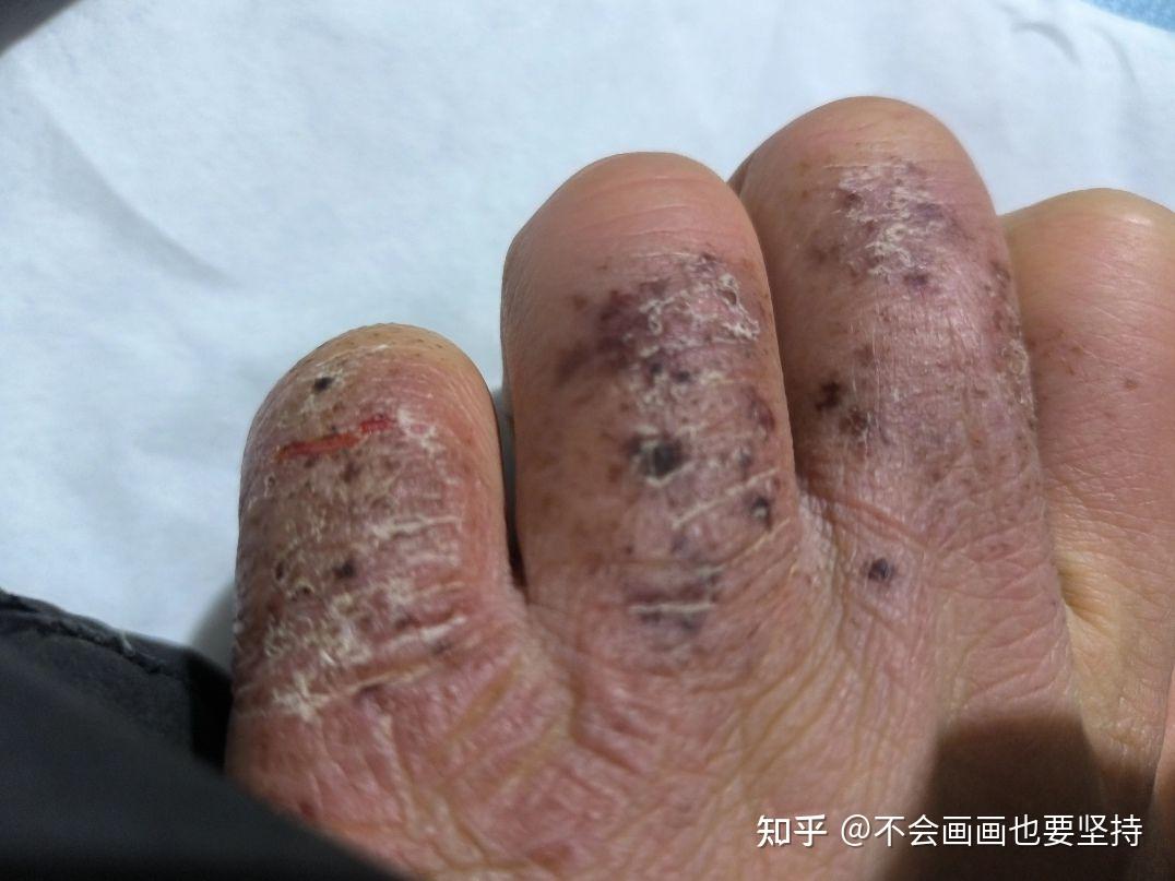 冻疮痒这么缓解 - 知乎