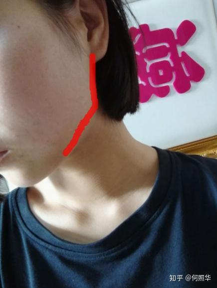 我这脸型还有救吗太阳穴凹陷脸也不对称下颌骨突出有什么拯救的办法吗