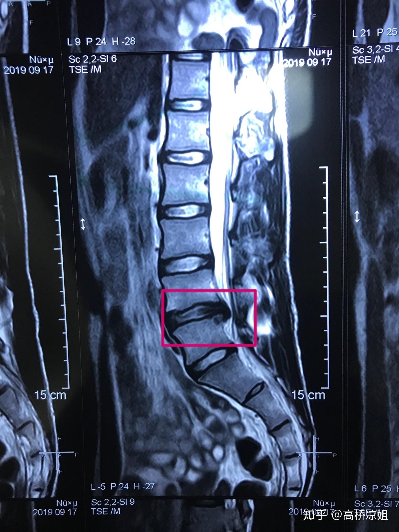 髂腰韧带的形态及其临床意义-脊柱外科临床解剖-医学