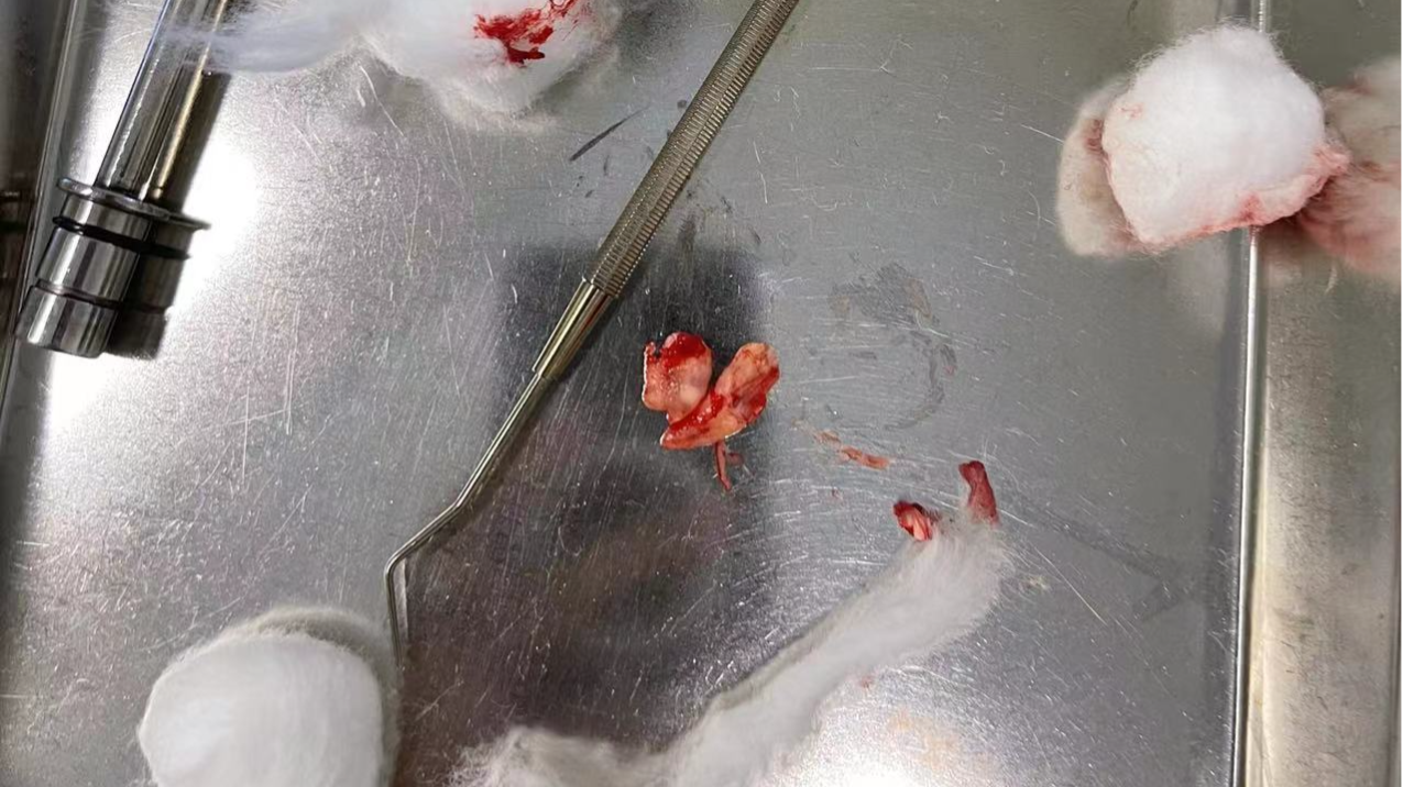 8月10日白天牙髓炎症状开始严重了,感觉要忍不住了,所以立即在网上找