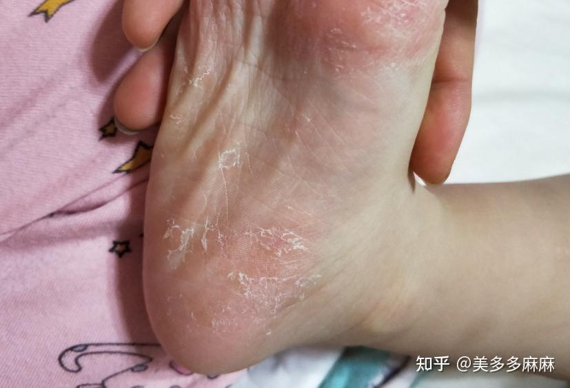 脚气有哪些症状