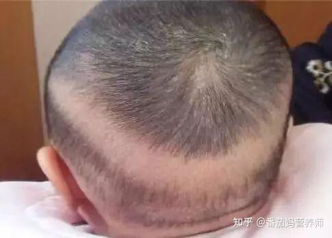 枕秃、夜惊、盗汗、O型腿都是缺钙吗? - 知乎