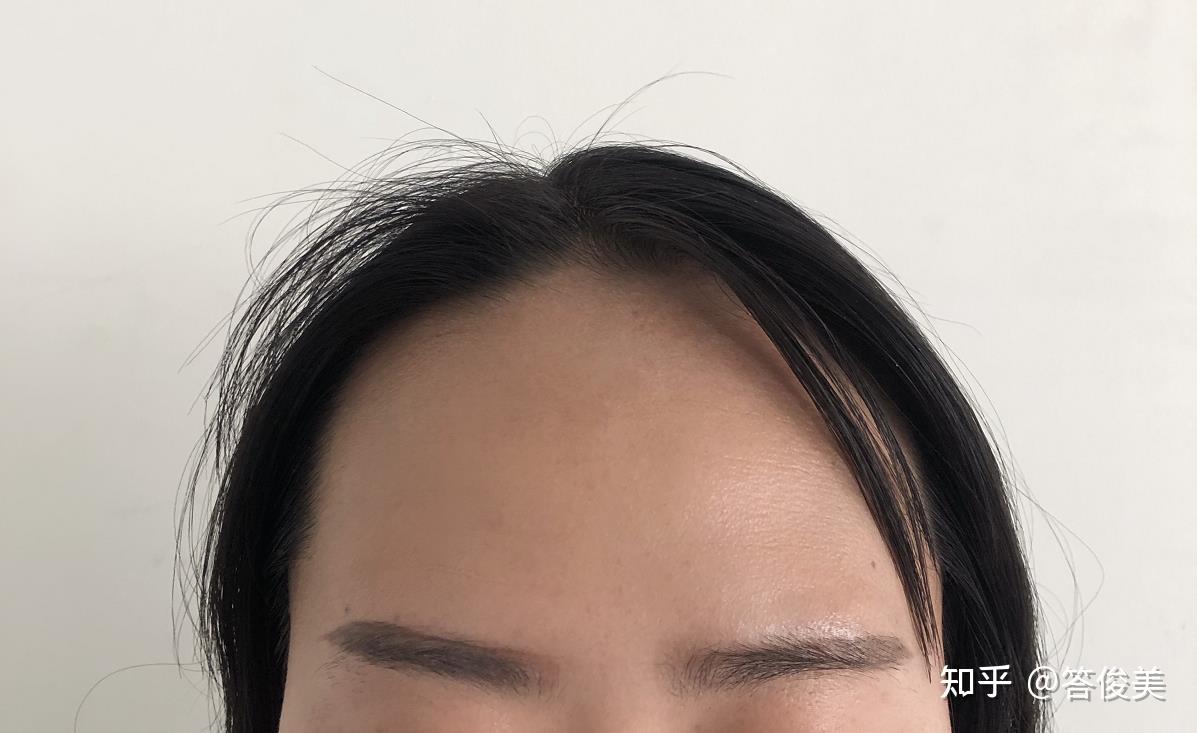 发际线后移太痛苦了,千方百剂洗发水可以拯救发际线吗? - 知乎