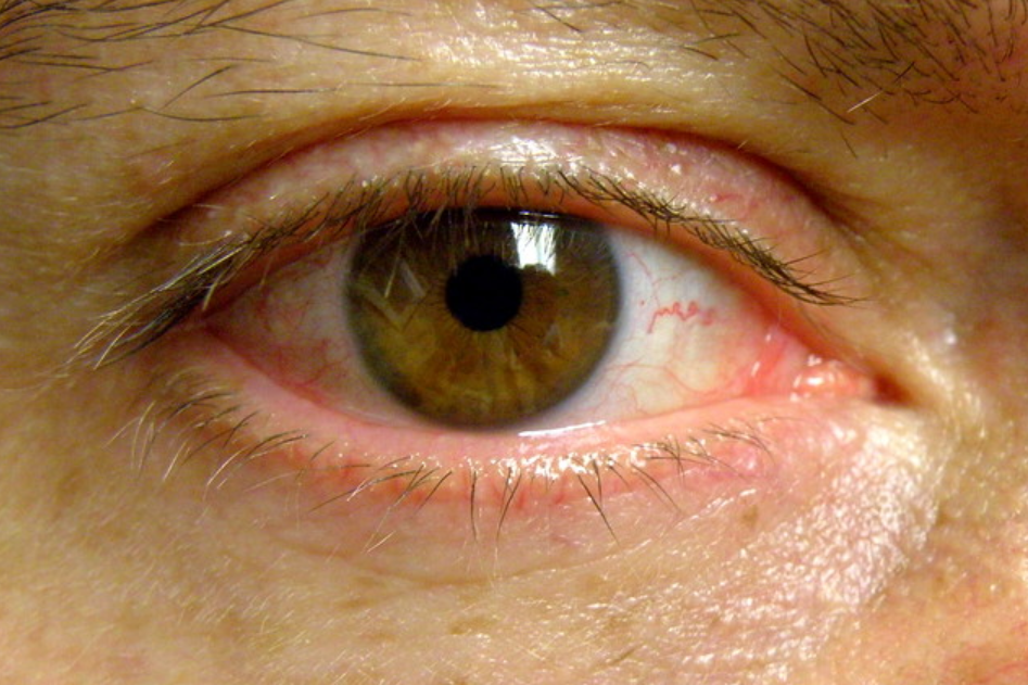 03:祛眼袋差点导致失明