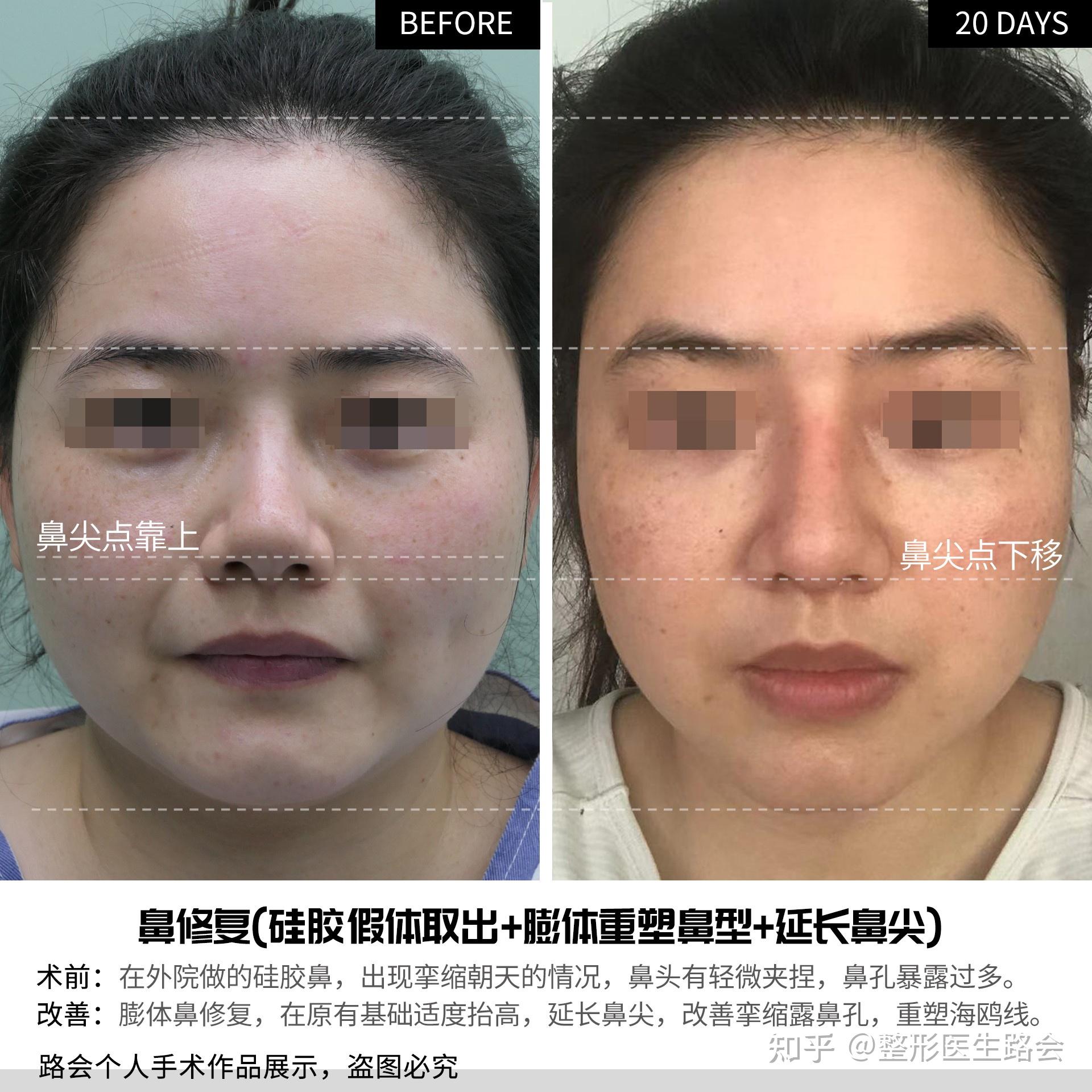 真是疯了，你怎么敢用膨体做鼻尖？鼻尖肯定要用自体软骨啊！ - 知乎