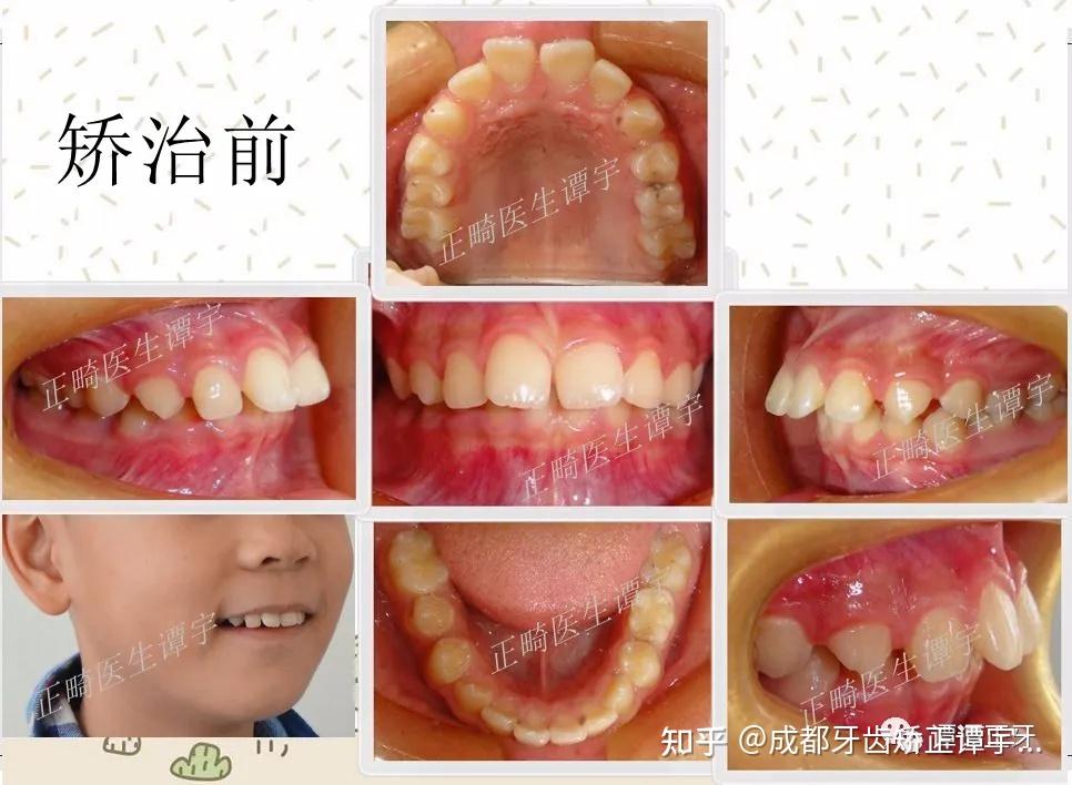 孩子几岁开始正牙