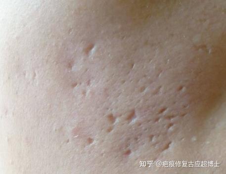 淡褐色痘印怎么去除? - 知乎