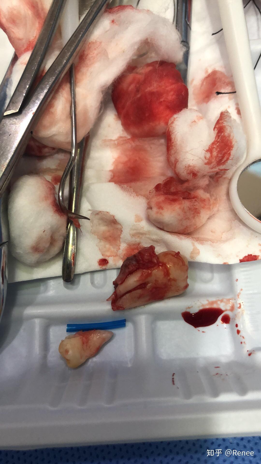 为什么两年前拔了智齿,现在同一个地方又长出来了一颗? - 知乎