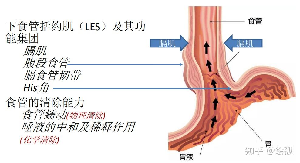 【消化系统】2.1胃食管反流病Gastroesophageal reflux disease(GERD) - 知乎