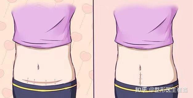 下腹原有纵凹陷巴痕腹壁成型该选什么q口