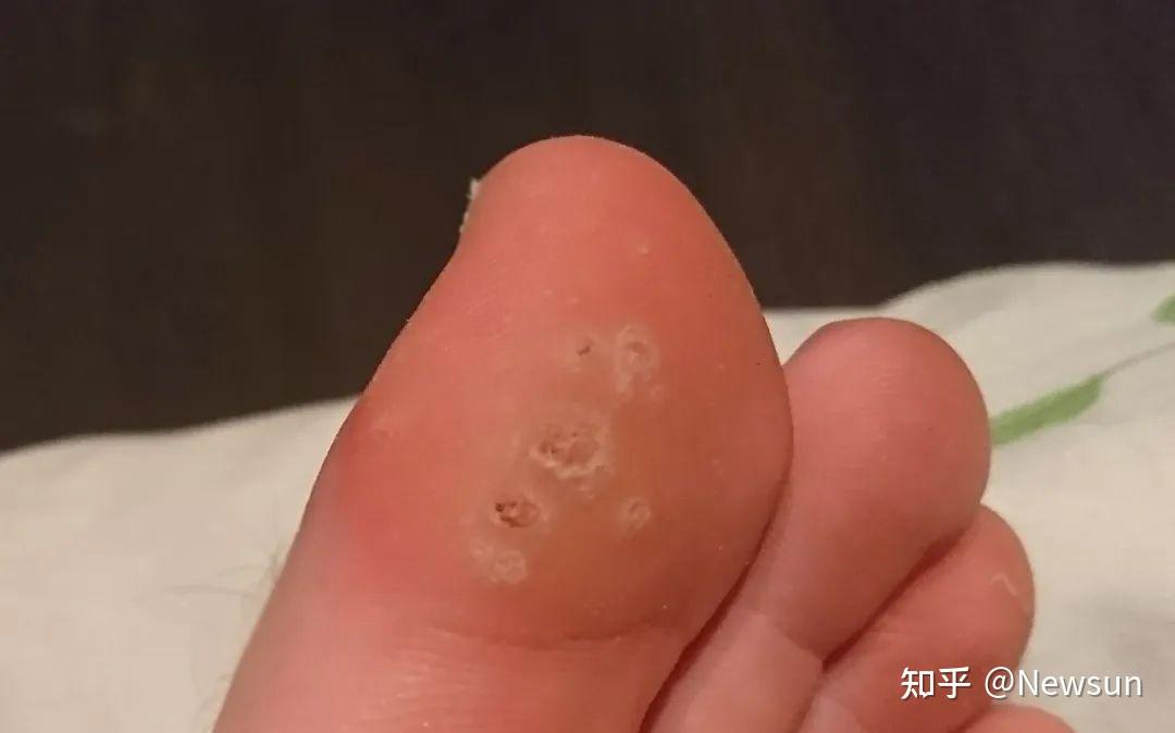 其中低危型感染占多数,一般仅会导致"疣"的产生;高危型hpv有十几种