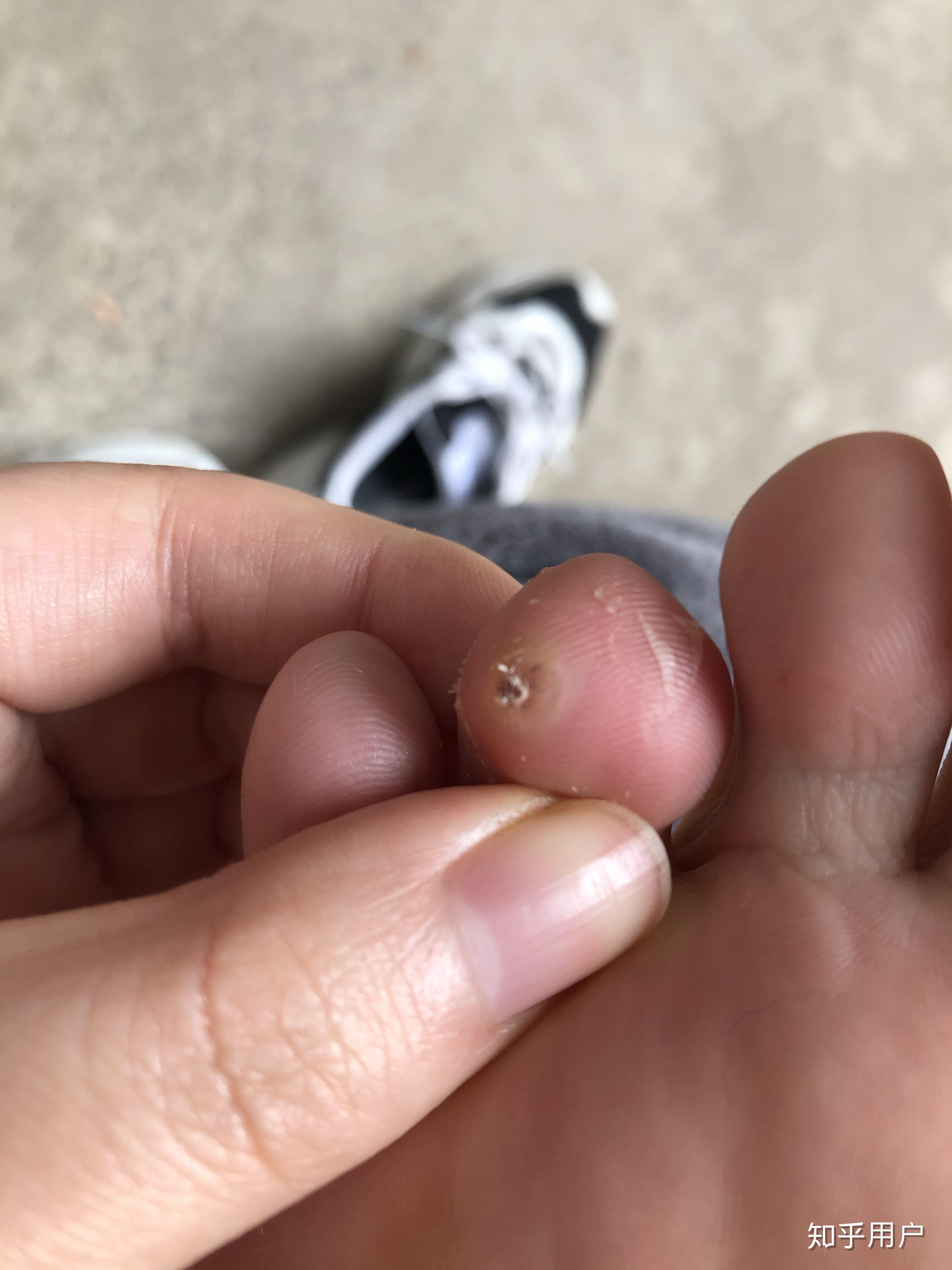 液氮冷冻治疗后手指上出了血泡而且越来越大该怎么办