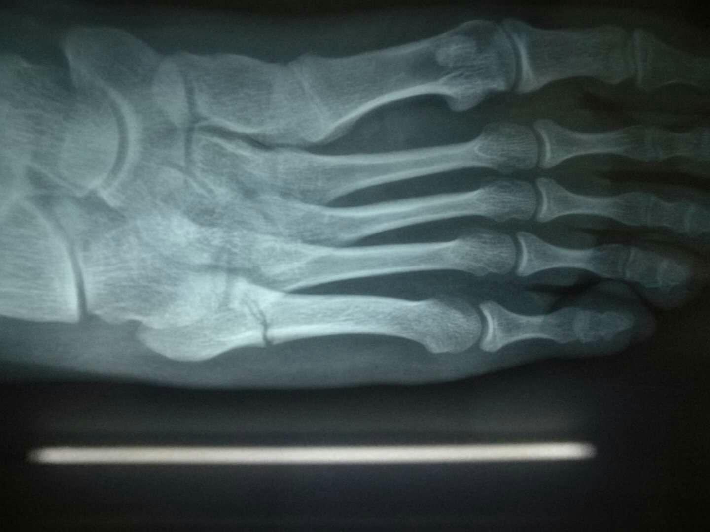 左脚第五跖骨骨折? 知乎 左脚第五跖骨骨折? 知乎