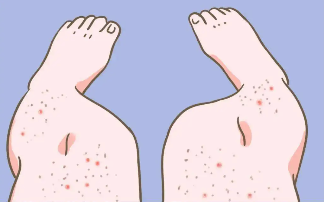 毛周角化症(鸡皮肤)本质上究竟是什么导致的,能改善吗? - 知乎