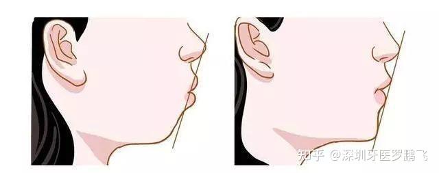 如何判断自己嘴凸? - 知乎