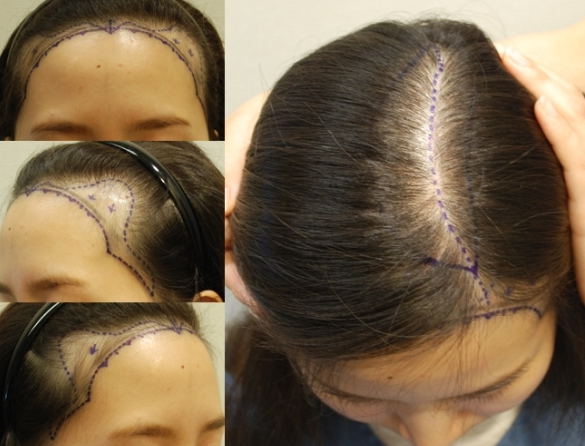 女性发际线矫正头顶加密5000毛植发来自患者分享