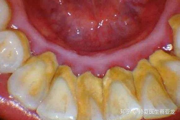 慢性龈炎 zhuanlan.zhihu.com