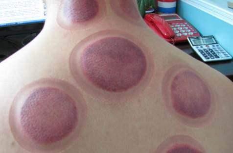 北京京通医院 中医科行政主任快约北京胃肠镜67中医拔罐的罐印颜色