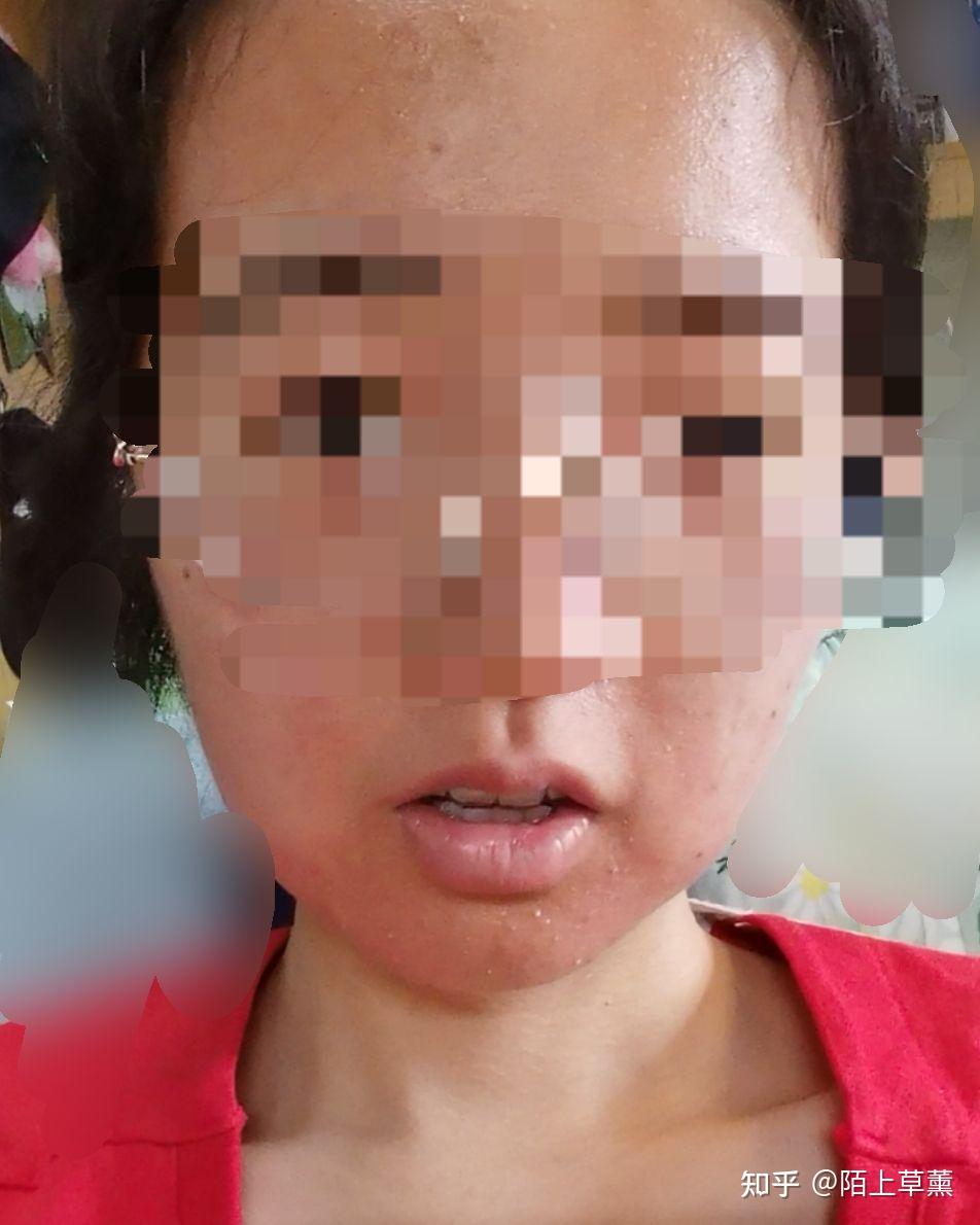 芒果过敏多久才会好啊啊啊