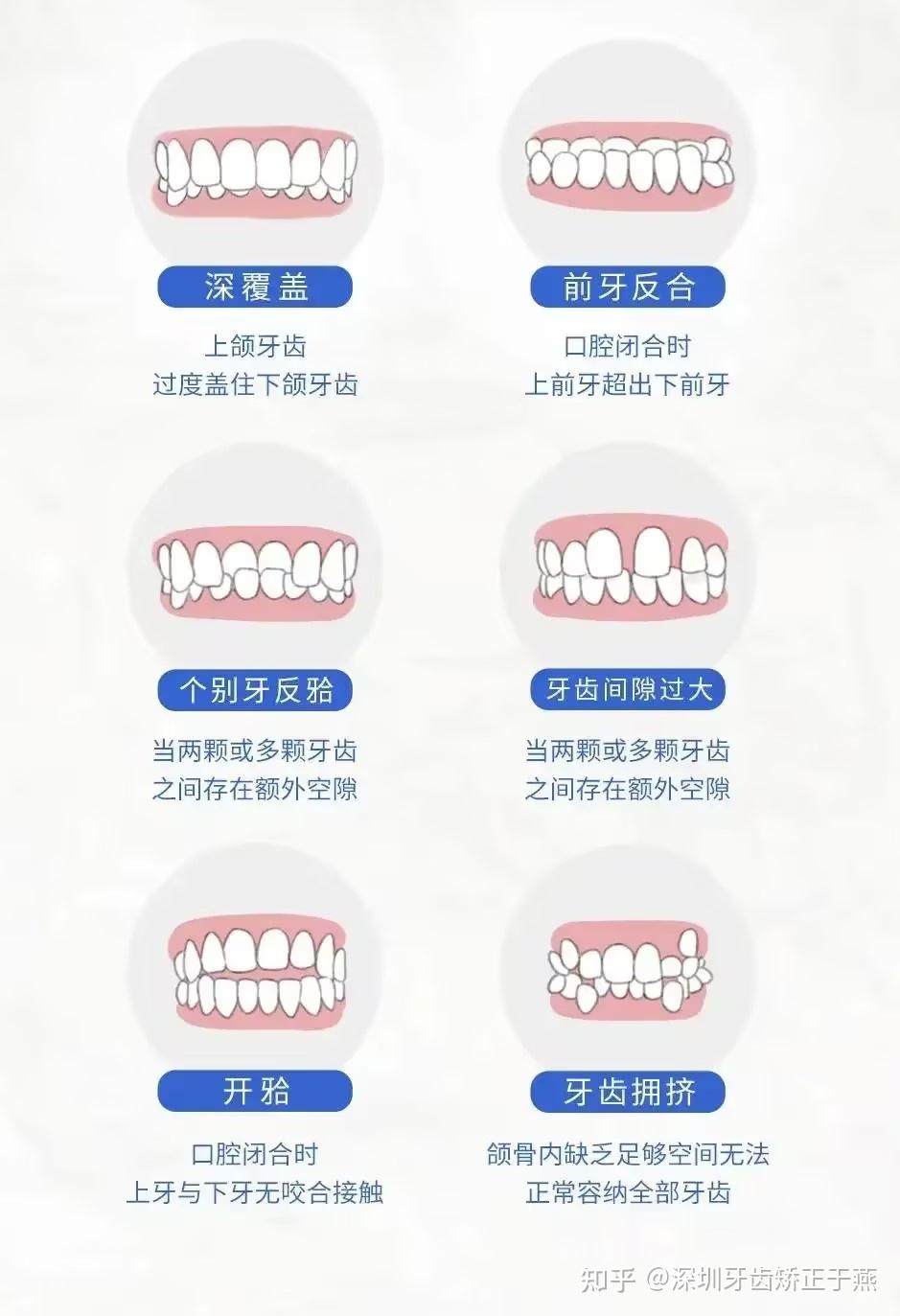 矫正牙齿价目表 正常图片