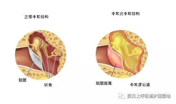 鼓室积液 zhuanlan.zhihu.com