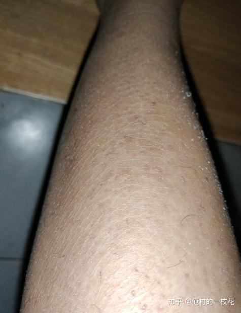 这是鱼鳞病皮肤,蛇皮肤吗?