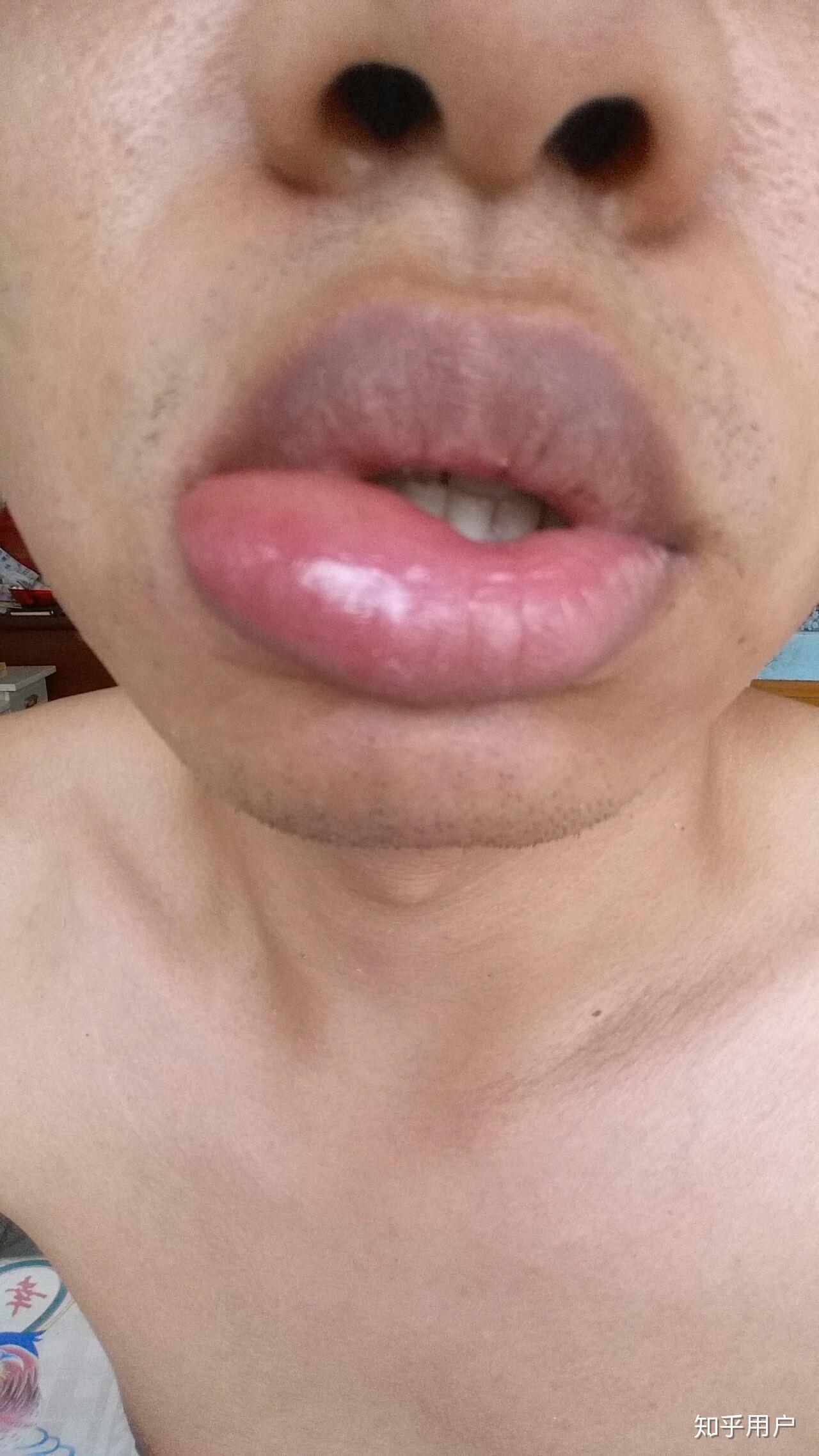 嘴唇上被咬到蚊子包是一种怎样的体验