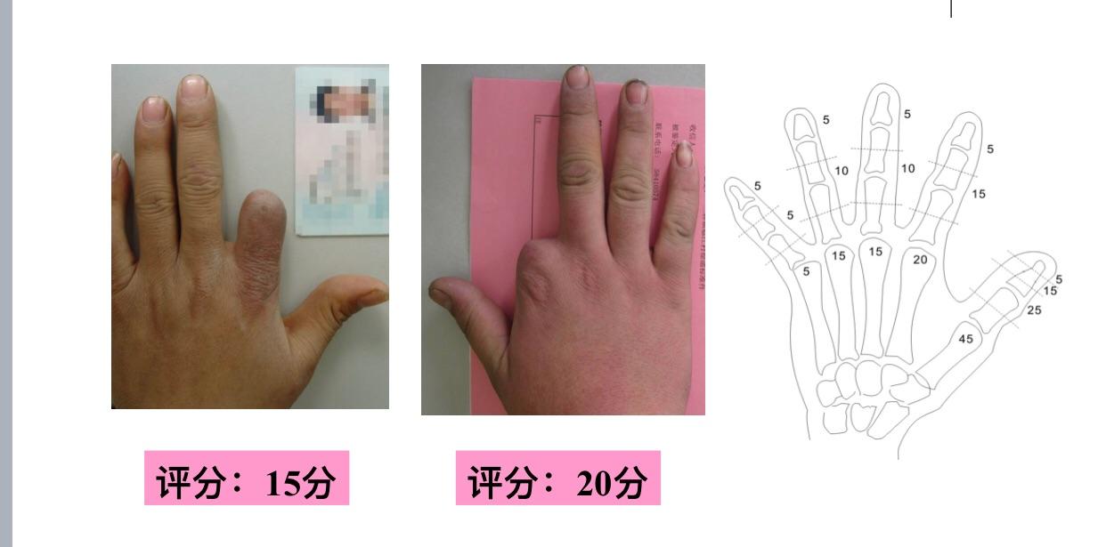 手被汽油枪喷伤,右手食指截一半,请问伤残鉴定够几级? - 知乎