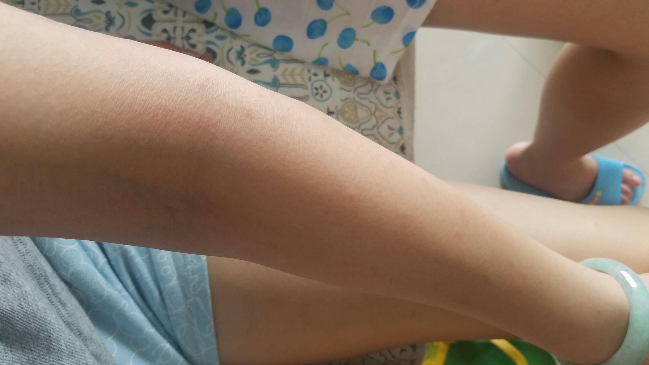 用过激光脱毛仪以后过敏一样有好多痒疙瘩怎么办? - 知乎