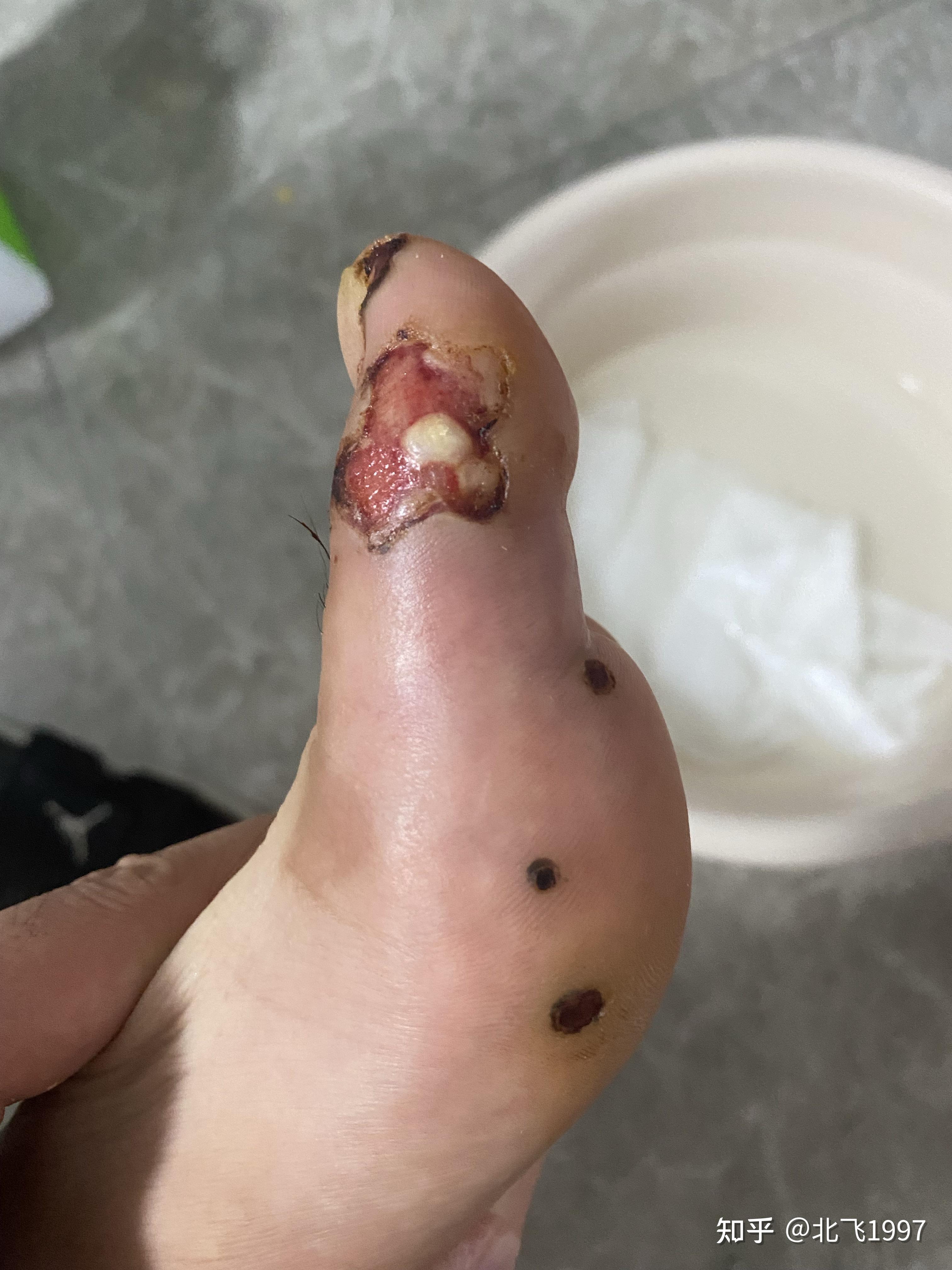 激光治疗趾疣历程记录分享