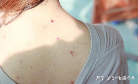 后背长痘是因为什么原因?背部长痘这么办即可 - 知乎