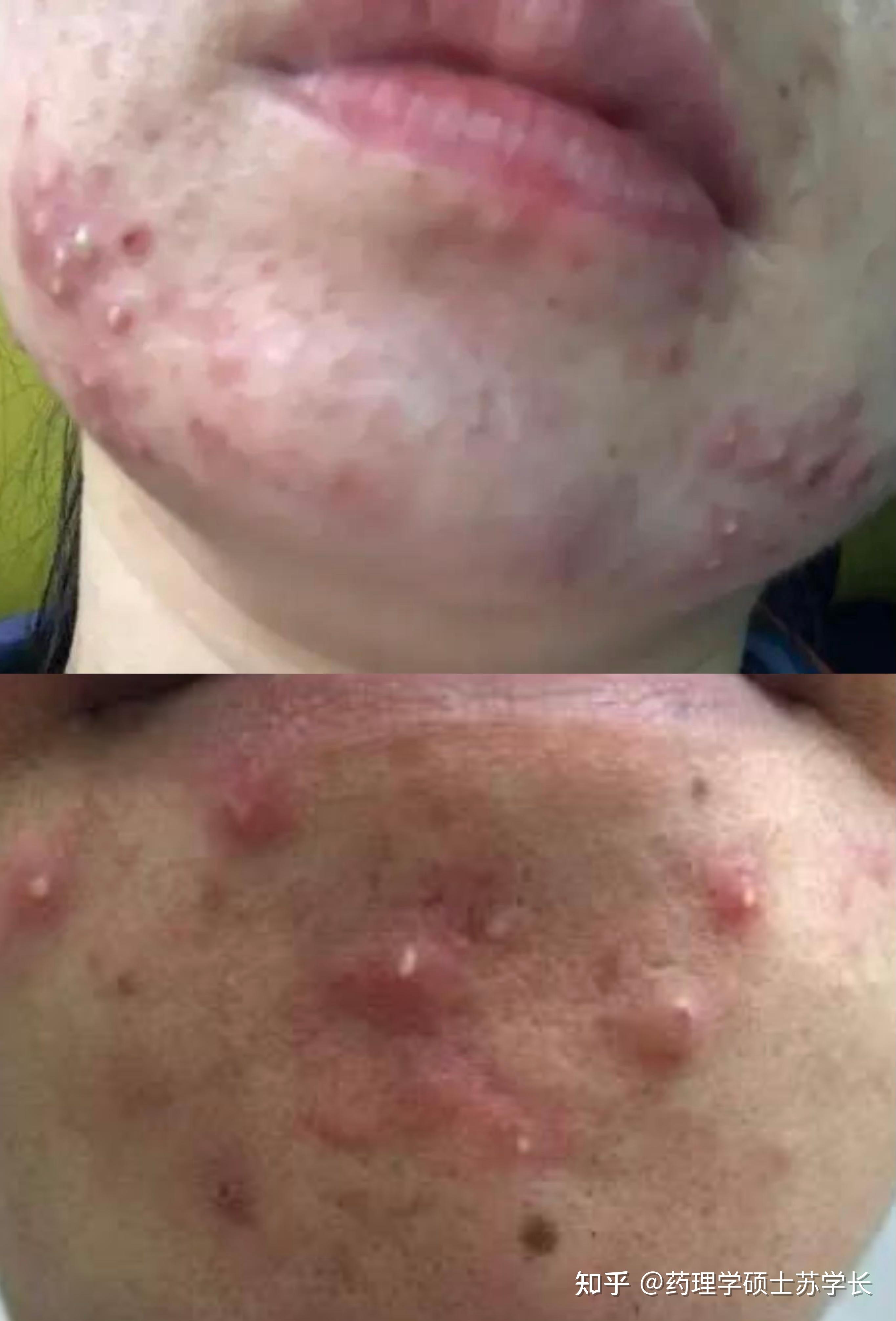 男生下巴反复长痘是什么原因有没有快速去下巴痘痘的方法有没有专业