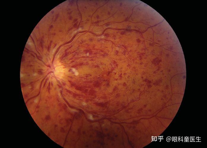 与系统性疾病相关的视网膜病变——5,眼缺血综合征