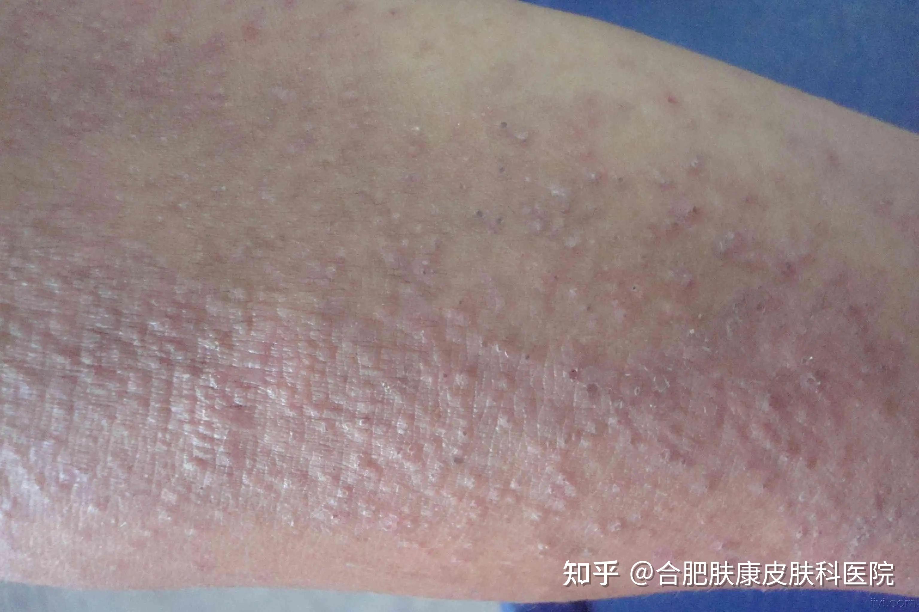 神经性皮炎能治愈吗? - 知乎