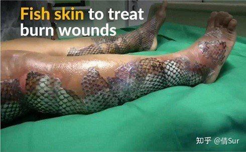 医院回应猪躺手术台被剥皮移植称猪皮将用于覆盖烧伤病人皮肤这一治疗