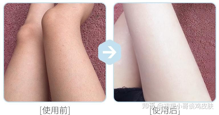 除鸡皮肤妙招(什么方法去除鸡皮肤) 除鸡皮肤妙招(什么方法去除鸡皮肤)